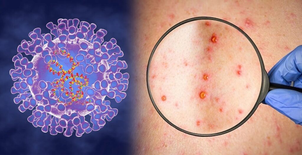 Maymun Çiçeği Hastalığı Tanı ve Tedavi Yöntemleri